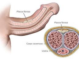 I noduli del pene