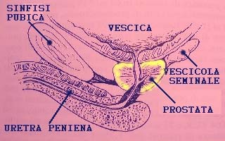 Le Prostatiti