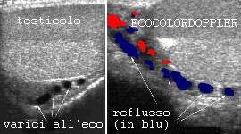 INFERTILITA’ MASCHILE: Il varicocele